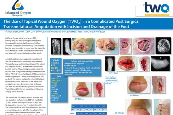 The Use of Topical Wound Oxygen (TWO2) in a Complicated Post Surgical Tranmetatarsal Amputation with Incision and Drainage of the Foot