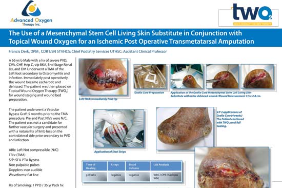 The Use of a Mesenchymal Stem Cell Living Skin Substitute in Conjunction with Topical Wound Oxygen for an Ischemic Post Operative Transmetatarsal Amputation