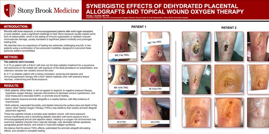 Synergistic Effects of Dehydrated Placental Allografts and Topical Wound Oxygen Therapy